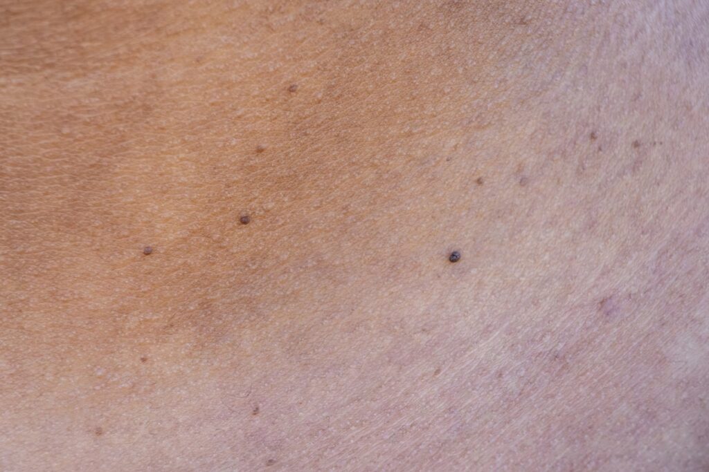 Buy Affordable Understanding Skin Tags: Causes, Removal Solutions & Prevention Tips in London, UK